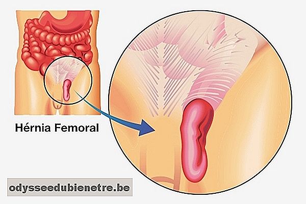 Principais sintomas da hérnia femoral e como é feito o tratamento