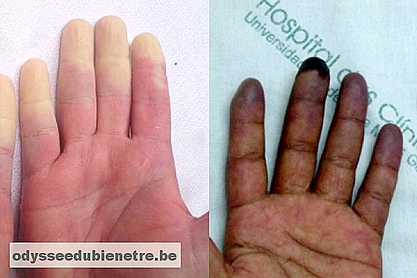 Doença de Raynaud: quando os dedos mudam de cor