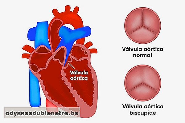 pierderea în greutate și stenoza de supapă aortică