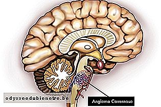 Angioma Cavernoso no tronco cerebral