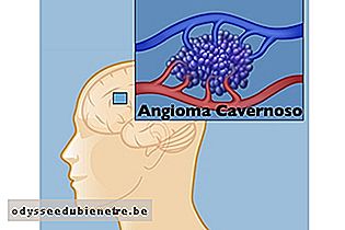 Angioma Cavernoso no cérebro