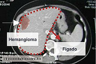 Tomografia do hemangioma no fígado
