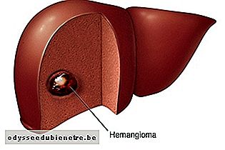 Hemangioma no fígado