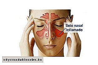 Seio nasal inflamado na sinusite