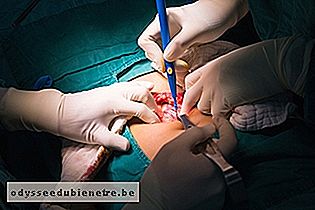 Cirurgia convencional