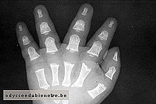 Mãos pequenas, largas e com dedos curtos presentes na Acondroplasia
