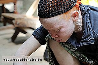 Entenda melhor o que é o Albinismo