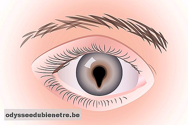 O que é a coloboma ocular e como tratar