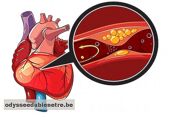 Como identificar e tratar a isquemia cardíaca