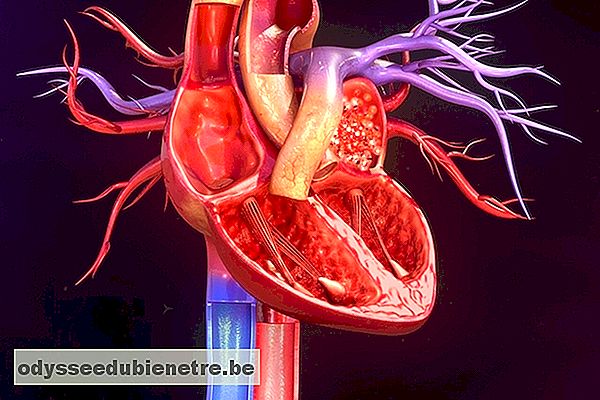 Sintomas da cardiomiopatia diabética e como tratar