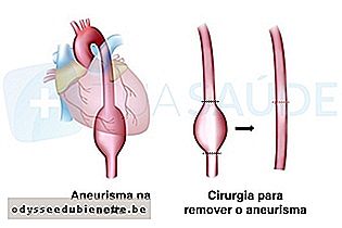 Cirurgia para remover o aneurisma