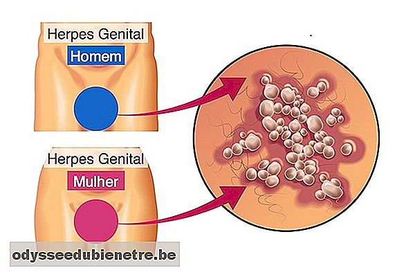 Aparência das bolhas ou feridas causadas pelo herpes genital no homem e na mulher