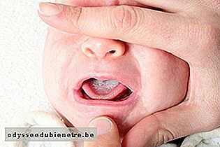 Como identificar e curar o Sapinho em Bebê