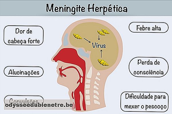 Como identificar e tratar a Meningite Herpética