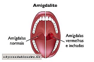 Como identificar e tratar a Amigdalite