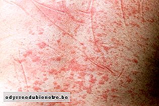 Manchas da dengue na pele