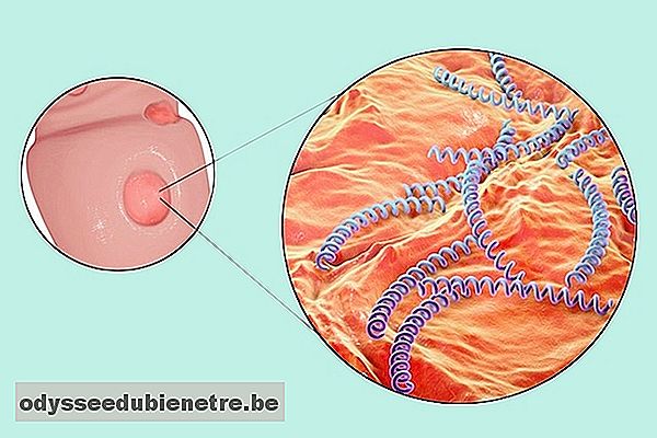 Úlcera causada pela infecção da bactéria Treponema pallidum