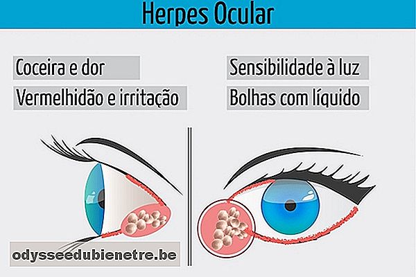 Entenda o que é a Herpes nos Olhos
