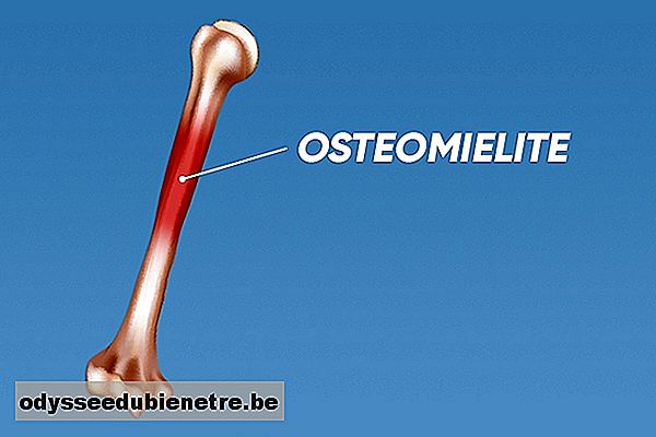 O que é osteomielite e como identificar