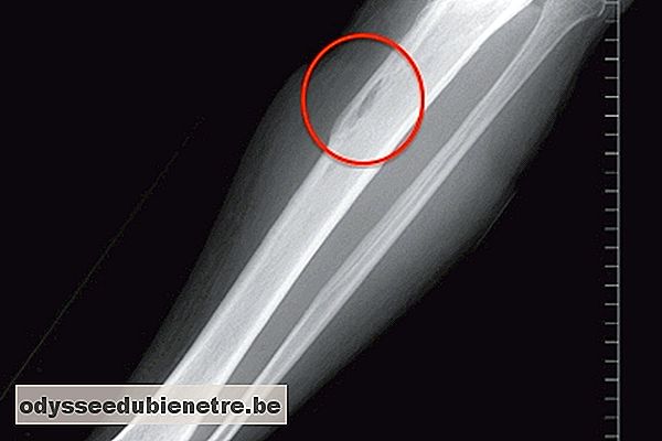 Raio-x do osso do braço com osteomielite
