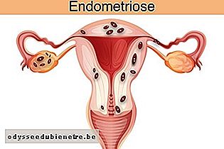 Sistema reprodutor feminino com Endometriose