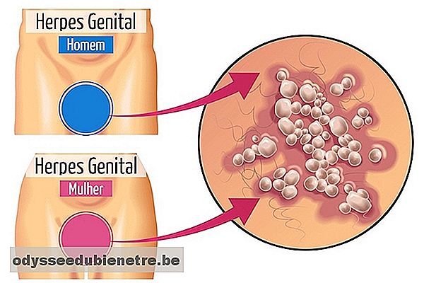 Veja como identificar os sintomas da Herpes Genital