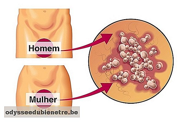 Aparência das bolhas causadas pelo herpes genital no homem e na mulher
