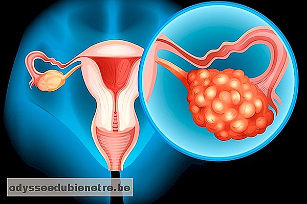 Como saber se é câncer de ovário