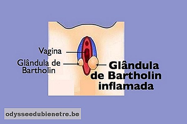 Como tratar a inflamação da glândula de Bartholin