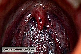 HPV na garganta