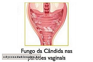 Candidíase vaginal
