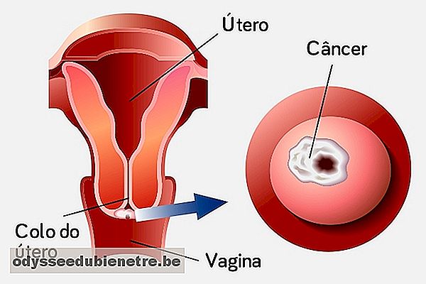 Sintomas de câncer de colo de útero
