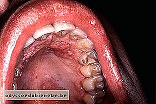 HPV no céu da boca