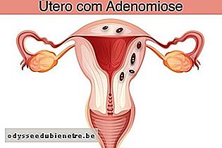Aparência de um útero com adenomiose com tecido dentro do músculo