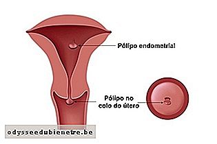 O que pode causar o Pólipo uterino