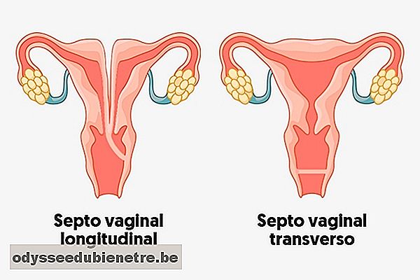 O que é o septo vaginal e como tratar