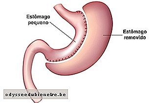 Estômago após gastrectomia vertical 