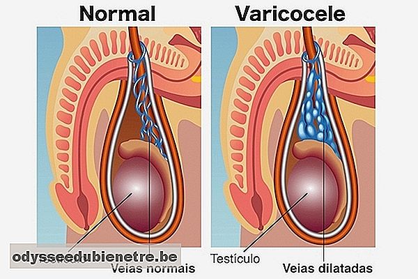 O que é a varicocele e como é feita a cirurgia