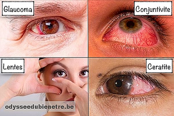 12 Causas e tratamentos para Dor nos Olhos