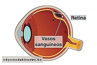 Descolamento da retina na retinopatia