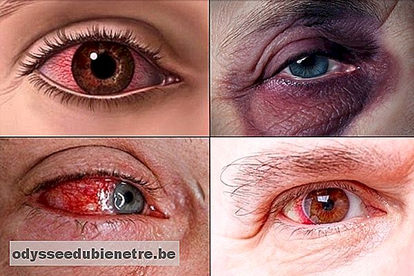 Como tratar um ferimento nos olhos