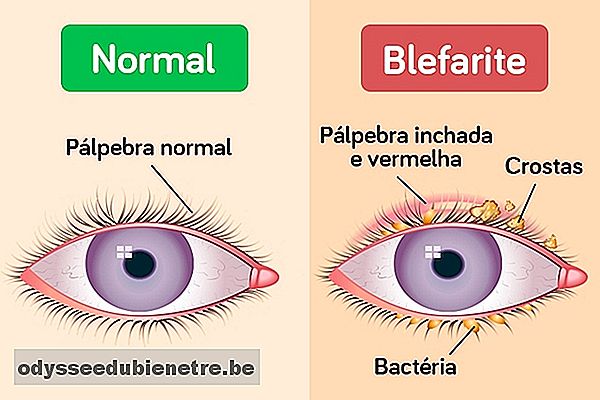 Pálpebra inchada e irritação nos olhos pode ser Blefarite