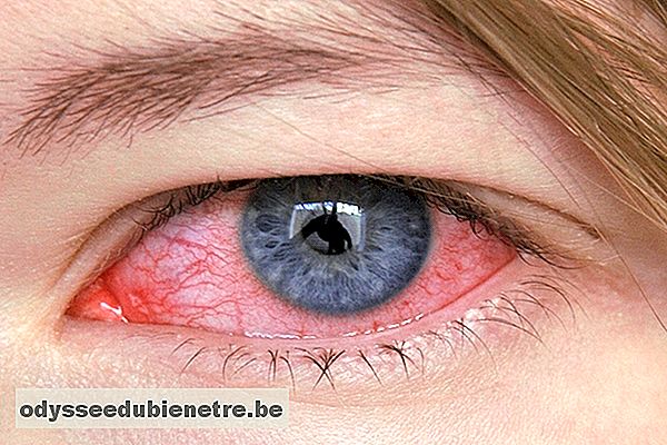 O que pode ser a vermelhidão nos olhos e como tratar