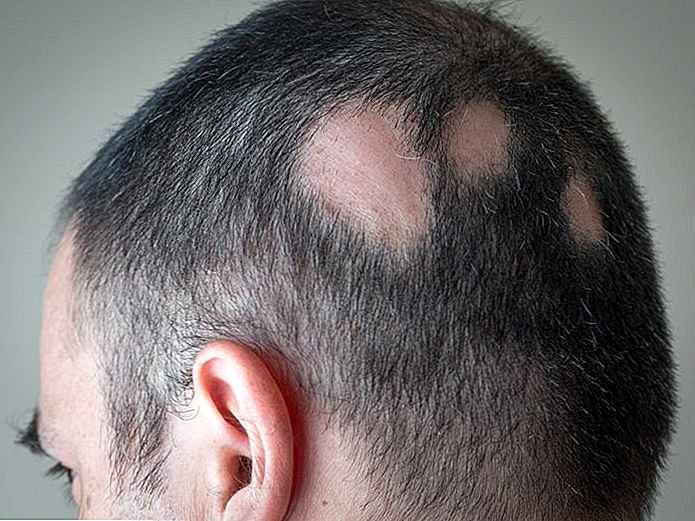 alopecia areata cura naturale