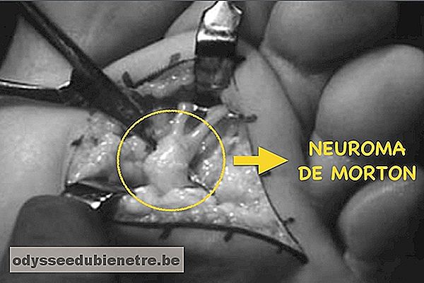 Cirurgia para remover Neuroma de Morton