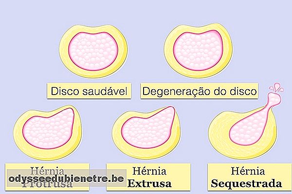 Tipos de hérnia de disco