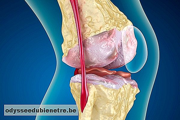 Como identificar e tratar a artrose no joelho