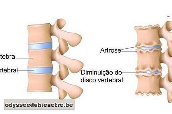 Artrose na coluna