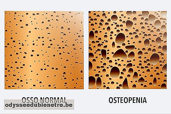 O que é e como identificar a Osteopenia
