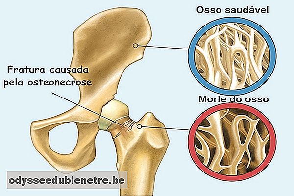 O que é Osteonecrose e como identificar
